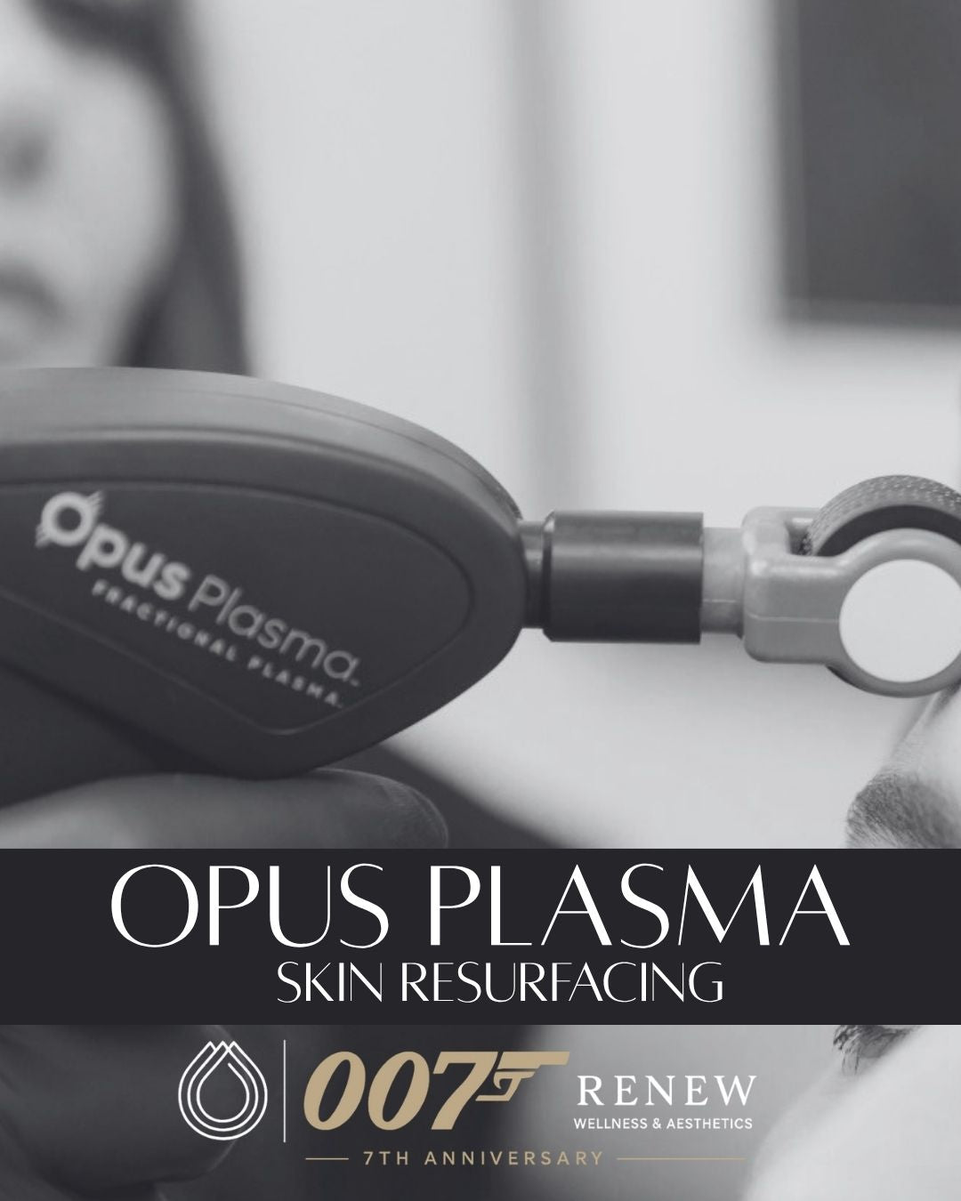 Opus Plasma Laser Resurfacing