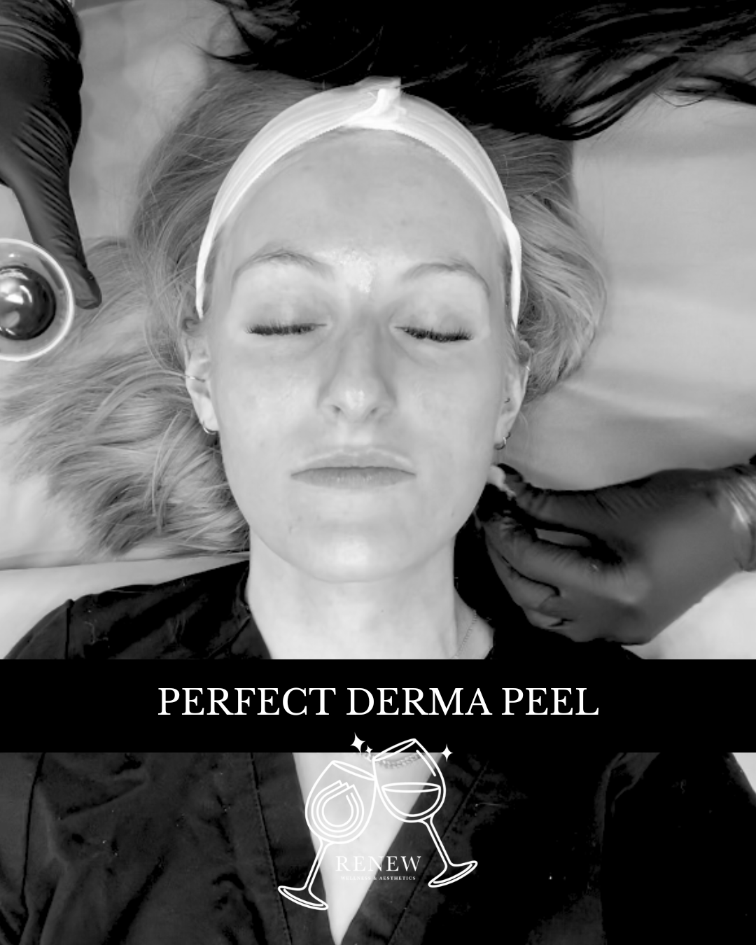 The Perfect Derma Peel - Renew Wellness & Aesthetics