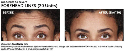 Tox BanksProcedure - Renew Wellness & Aesthetics