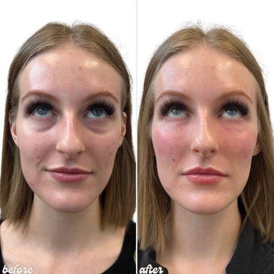 EZ GelProcedure - Renew Wellness & Aesthetics