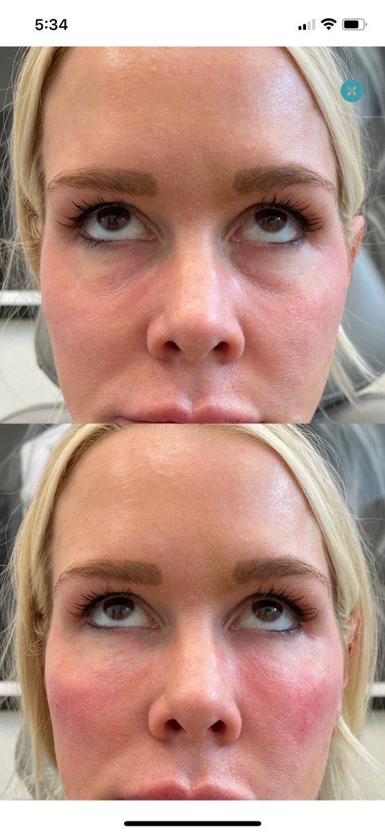 EZ GelProcedure - Renew Wellness & Aesthetics