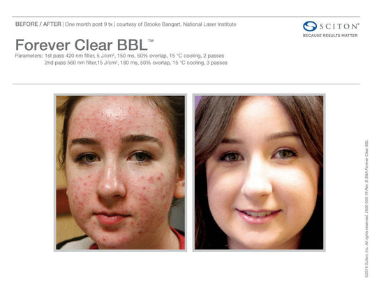 Forever Clear Acne TreatmentProcedure - Renew Wellness & Aesthetics