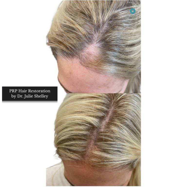 PRP Hair RestorationProcedure - Renew Wellness & Aesthetics