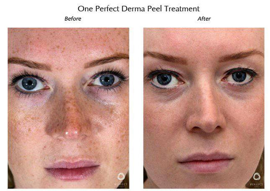 The Perfect Derma PeelProcedure - Renew Wellness & Aesthetics