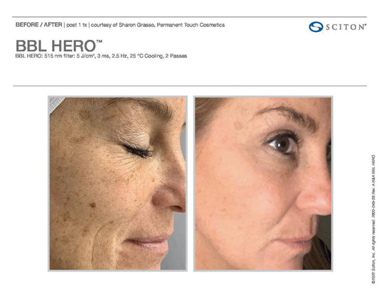 BBL HeroProcedure - Renew Wellness & Aesthetics