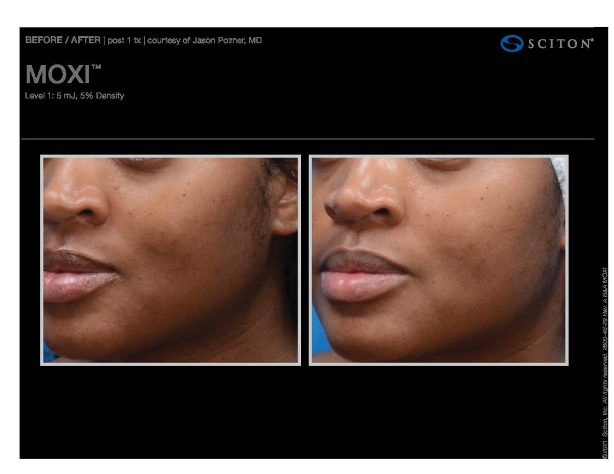 MoxiProcedure - Renew Wellness & Aesthetics