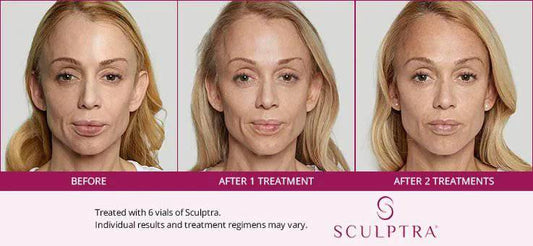 SculptraProcedure - Renew Wellness & Aesthetics