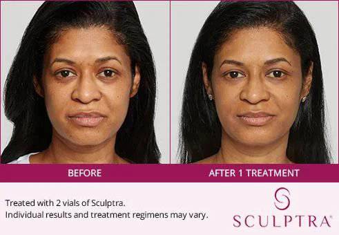 SculptraProcedure - Renew Wellness & Aesthetics