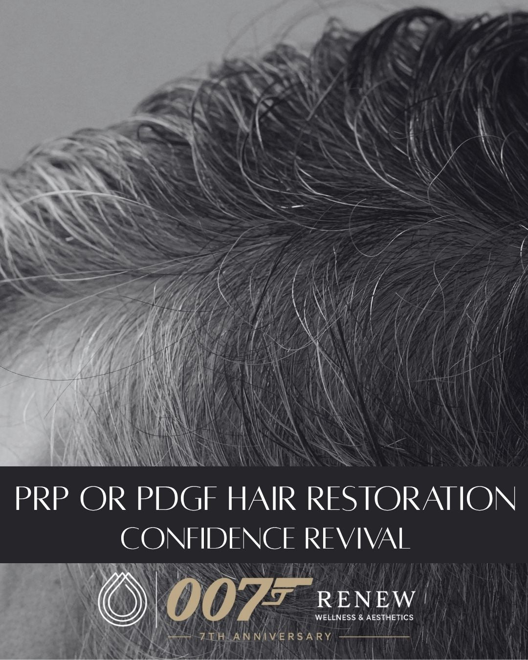 PRP or PDGF Hair Restoration