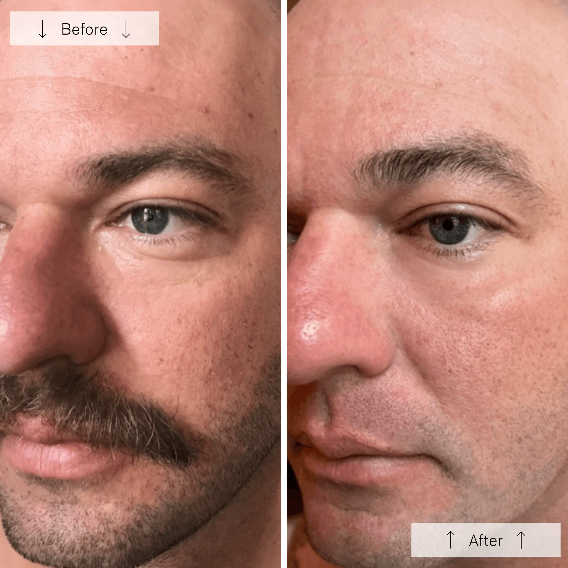 Omnilux Men LED Therapy Mask - Renew Wellness & Aesthetics 