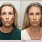 Volume Renewal - Non Surgical Fat Transfer (Renuva)