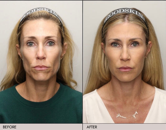 Volume Renewal - Non Surgical Fat Transfer (Renuva)