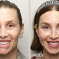 Volume Renewal - Non Surgical Fat Transfer (Renuva)