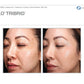 Sciton Tribrid Laser-Ultimate Skin Renewal