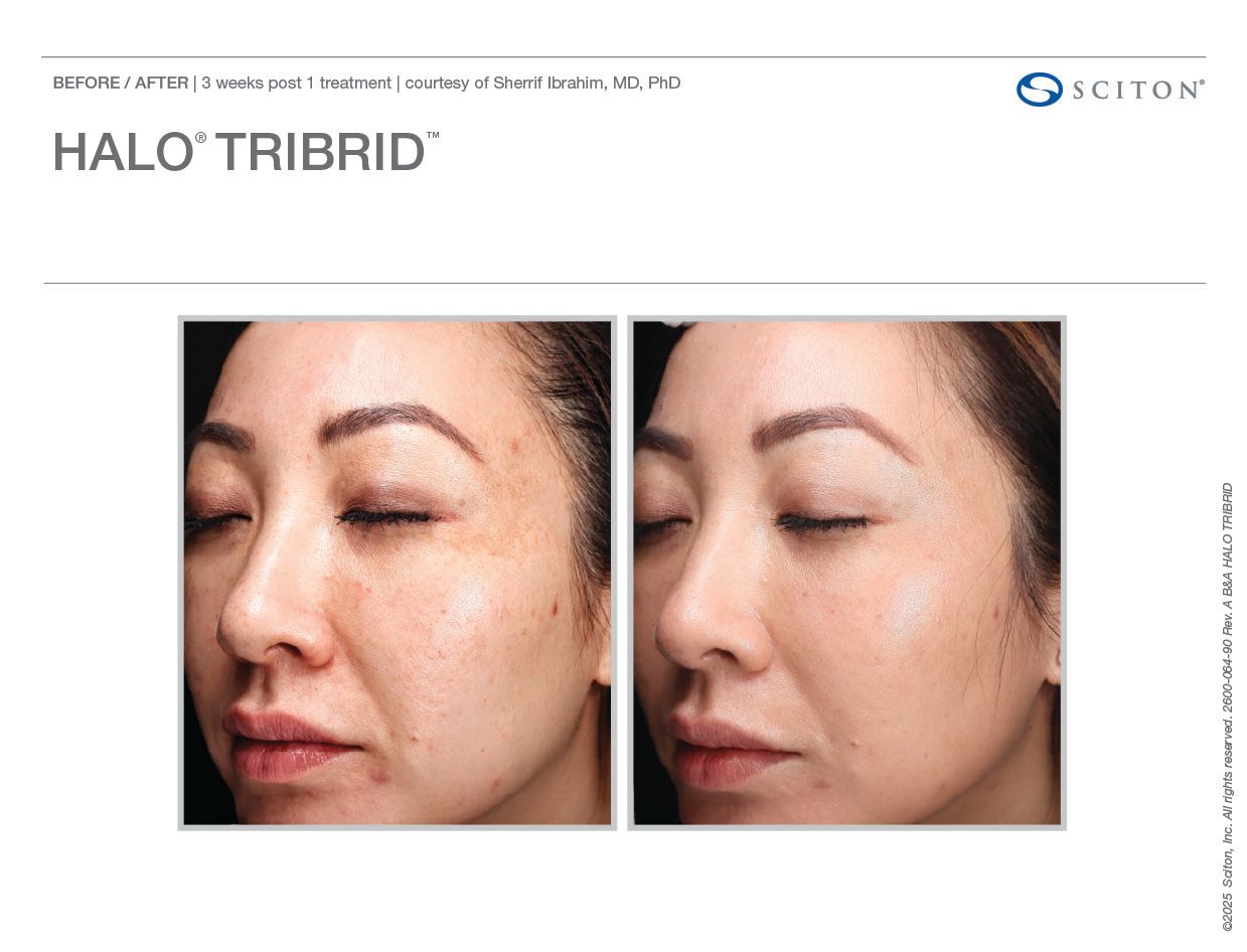 Sciton Tribrid Laser-Ultimate Skin Renewal