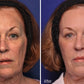 Volume Renewal - Non Surgical Fat Transfer (Renuva)