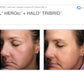 Sciton Tribrid Laser-Ultimate Skin Renewal
