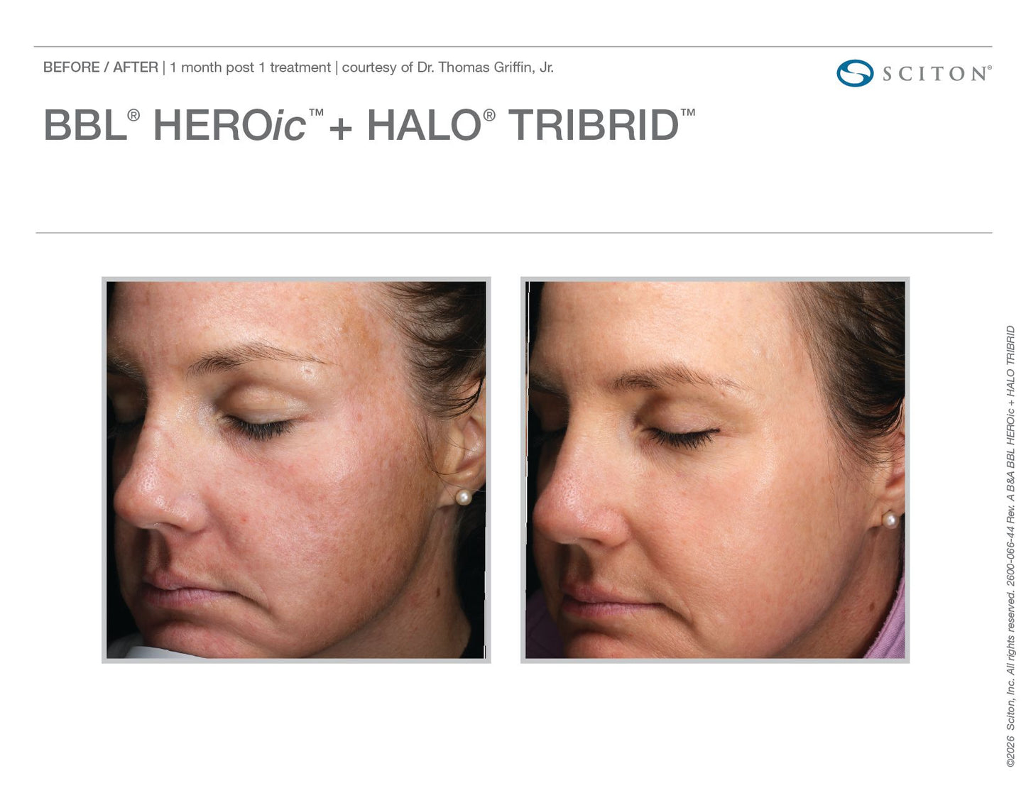 Sciton Tribrid Laser-Ultimate Skin Renewal