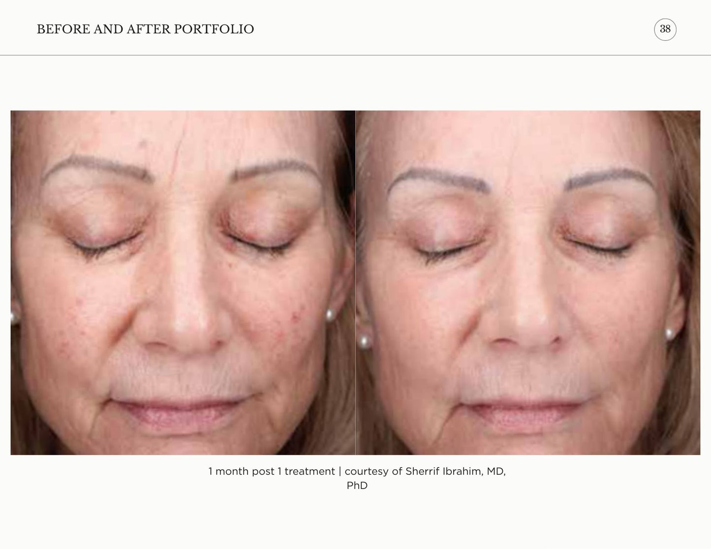 Sciton Tribrid Laser-Ultimate Skin Renewal