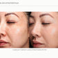Sciton Tribrid Laser-Ultimate Skin Renewal