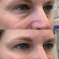 Under Eye Treatment (PDGF & EZ Gel)- BRIGHT EYES