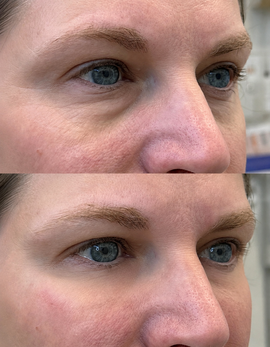 Under Eye Treatment (PDGF & EZ Gel)- BRIGHT EYES
