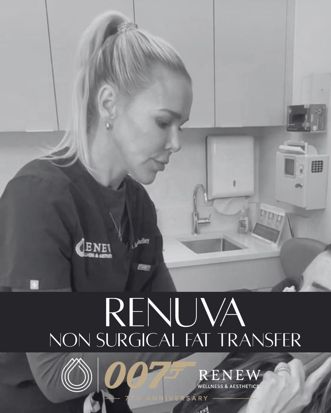 Volume Renewal - Non Surgical Fat Transfer (Renuva)