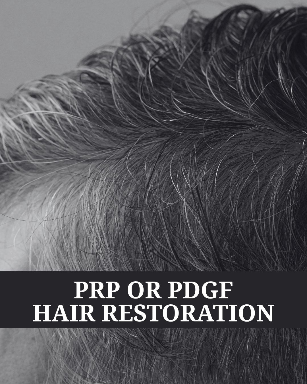 PRP or PDGF Hair Restoration