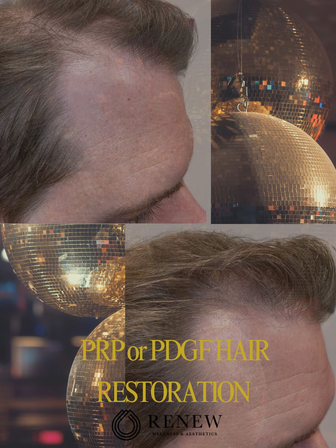 PRP or PDGF Hair Restoration