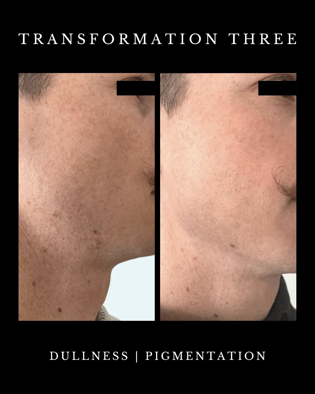 Men, do you want to age backwards FROM HOME? Your skin is 25% thicker. That means it demands treatments that work harder and penetrate deeper. The Omnilux Men Red Light Therapy Mask is FDA-approved and specifically engineered to: 

💪🏼 Reduce Wrinkles
💪🏼 Minimize Eye Bags
💪🏼 Calm Post-Shave Irritation 
💪🏼 Fade Dark Spots
💪🏼 Improve Skin Texture

Shop the link above! Pick-up in store or ship with UPS! 

#OmniluxMen #RedLightTherapy #MensSkincare