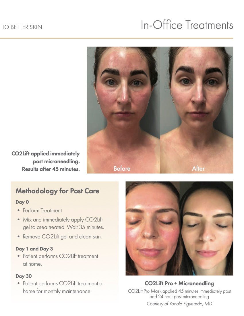 CO2Lift® Pro Carboxy Gel Mask - 1 Home TreatmentAnti - Aging - Renew Wellness & Aesthetics