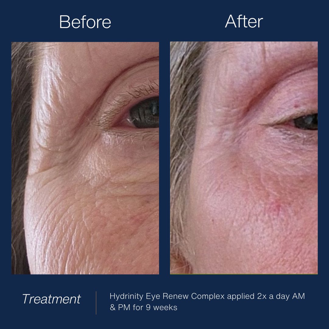 Hydrinity Eye Renew ComplexEye Care - Renew Wellness & Aesthetics