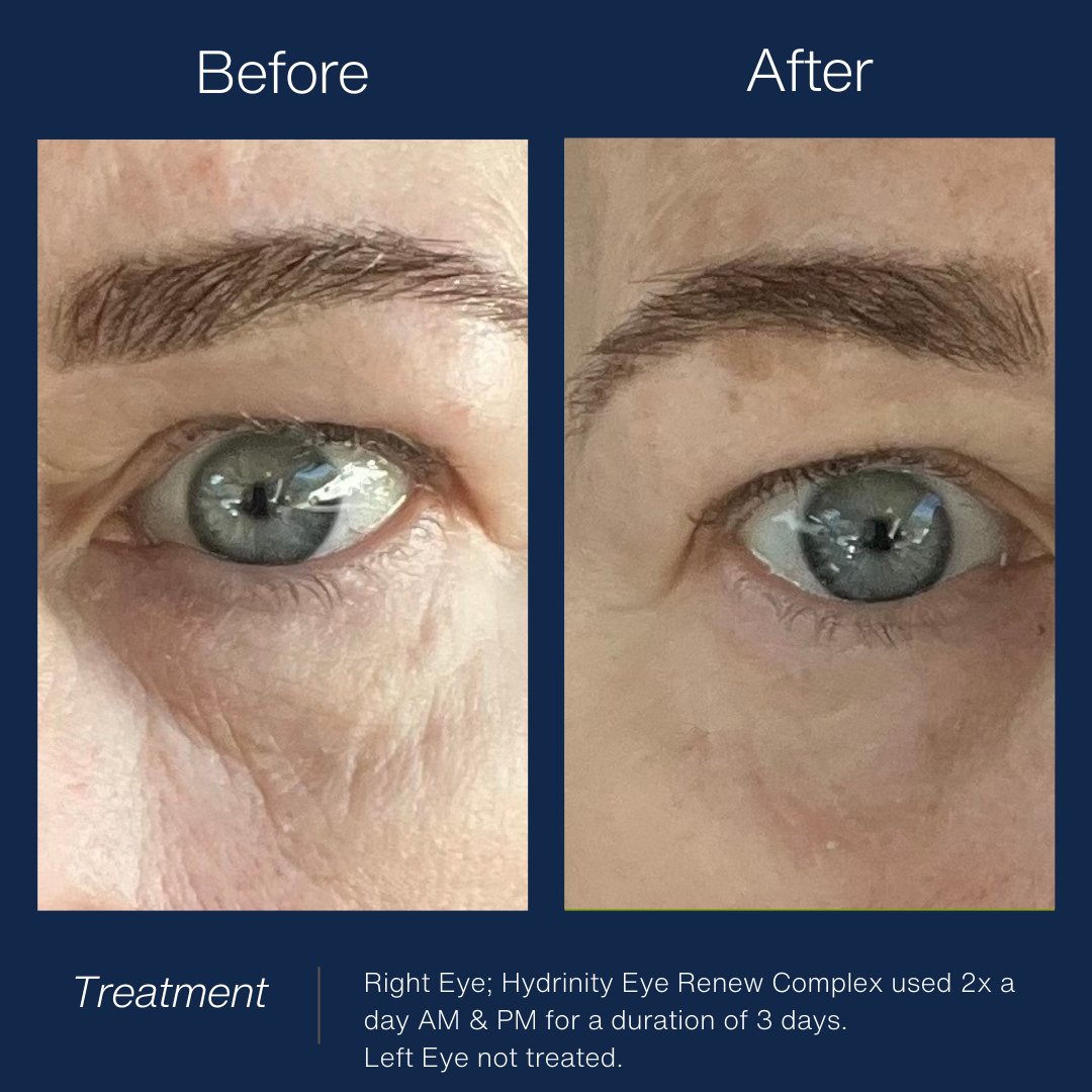 Hydrinity Eye Renew ComplexEye Care - Renew Wellness & Aesthetics