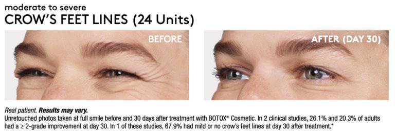 Tox BanksProcedure - Renew Wellness & Aesthetics