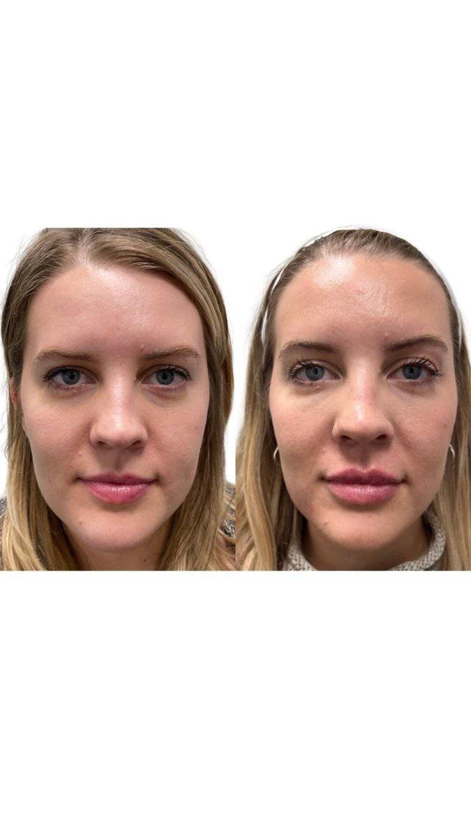 Dermal FillerProcedure - Renew Wellness & Aesthetics