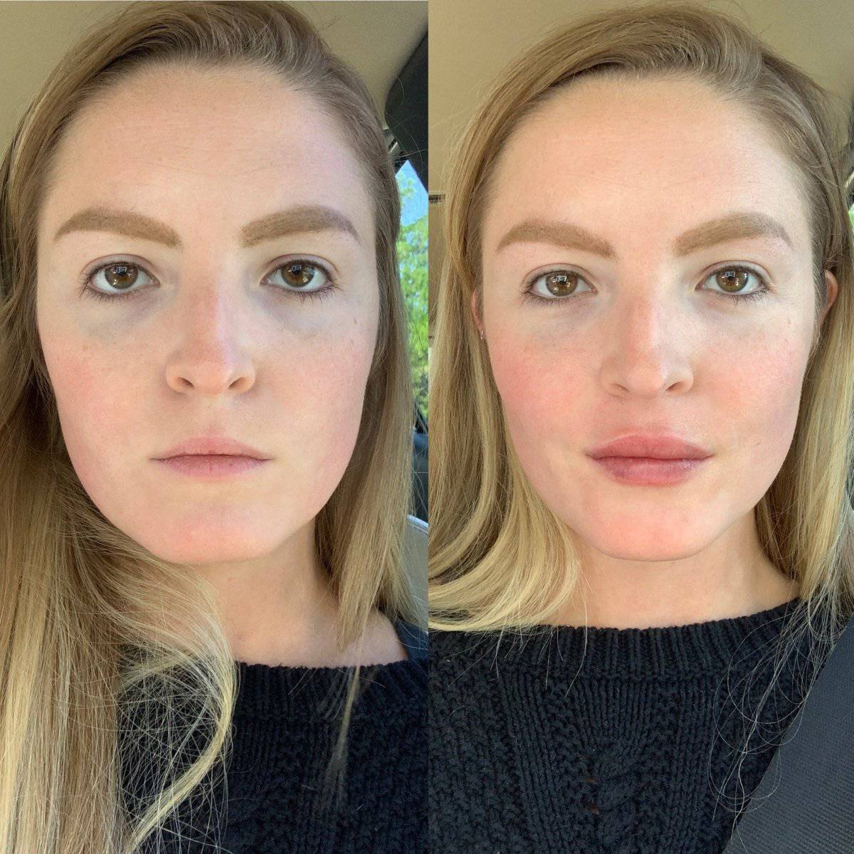 Dermal FillerProcedure - Renew Wellness & Aesthetics