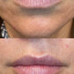 Dermal FillerProcedure - Renew Wellness & Aesthetics