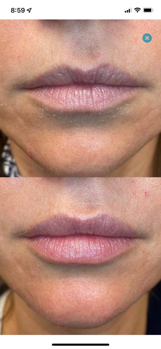 Dermal FillerProcedure - Renew Wellness & Aesthetics