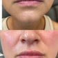 Dermal FillerProcedure - Renew Wellness & Aesthetics