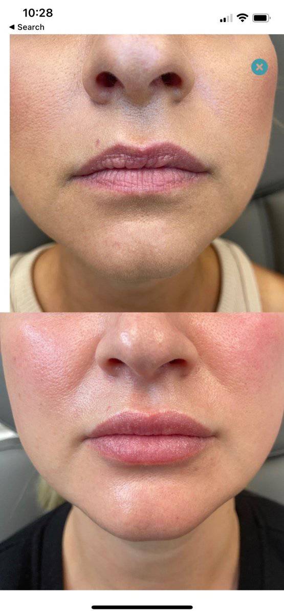 Dermal FillerProcedure - Renew Wellness & Aesthetics