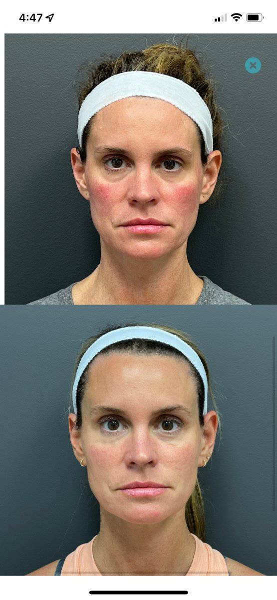 Dermal FillerProcedure - Renew Wellness & Aesthetics