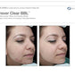 Forever Clear Acne TreatmentProcedure - Renew Wellness & Aesthetics