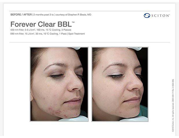 Forever Clear Acne TreatmentProcedure - Renew Wellness & Aesthetics