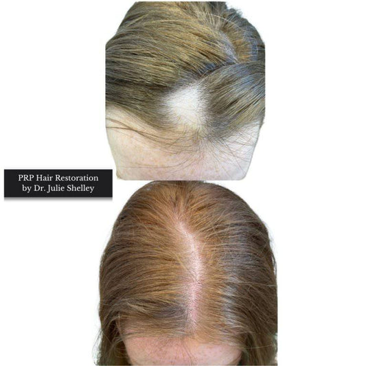 PRP Hair RestorationProcedure - Renew Wellness & Aesthetics