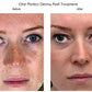 The Perfect Derma PeelProcedure - Renew Wellness & Aesthetics