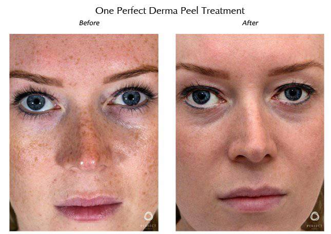 The Perfect Derma PeelProcedure - Renew Wellness & Aesthetics