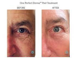 The Perfect Derma PeelProcedure - Renew Wellness & Aesthetics