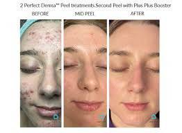 The Perfect Derma PeelProcedure - Renew Wellness & Aesthetics