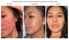 The Perfect Derma PeelProcedure - Renew Wellness & Aesthetics