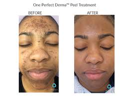 The Perfect Derma PeelProcedure - Renew Wellness & Aesthetics